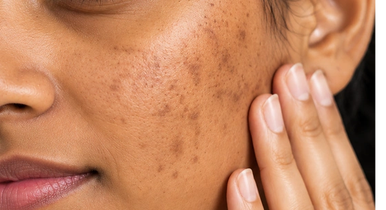 How to Get Rid of Pigmentation on the Face